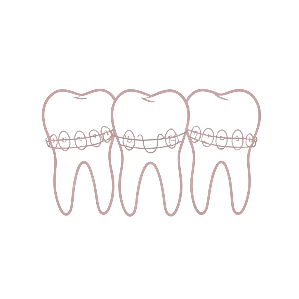 Ilustración de dientes con brackets y arco de ortodoncia